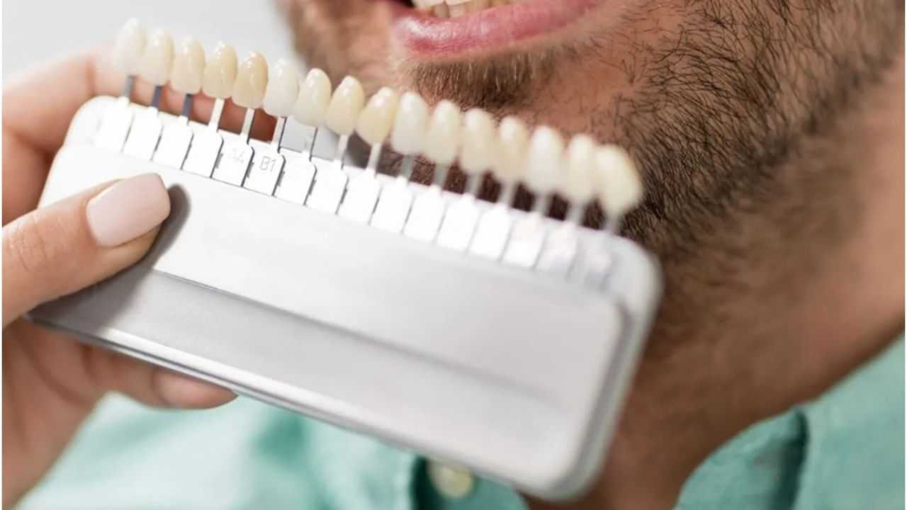 Porcelain Veneers